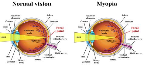 what is considered severe myopia.
